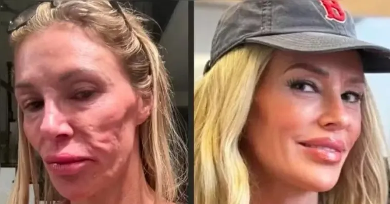 Criadora de conteúdo gasta R$ 1 milhão após “derretimento facial”